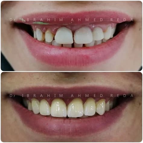 Before And After Emax Teeth Veneers Veneers Teeth Dental Veneers Gap