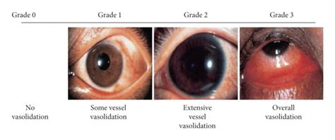 Standard Photographs Of The Severity Of Conjunctival Hyperaemia By