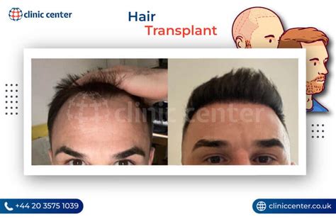 Hair Transplant In Turkey Cost Packages Hair Clinic Turkeyistanbul