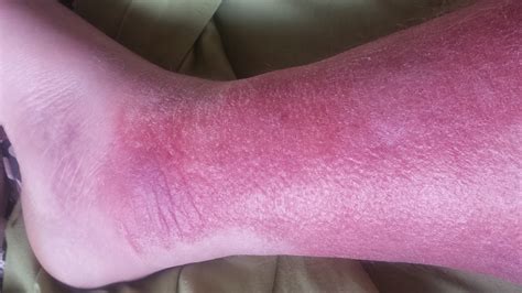 Bubbamikes Ramblings Cellulitis Warning Graphic Photos In This Post