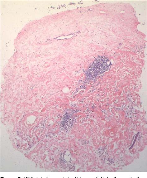 Figure 3 From Bullous Hemorrhagic Lichen Sclerosus Of The Breast A