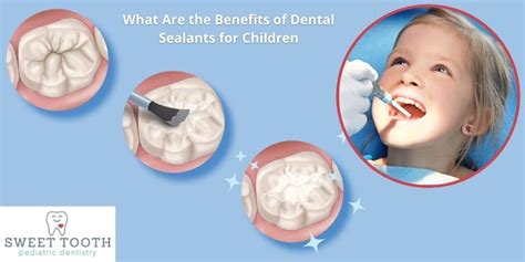 What Are The Benefits Of Dental Sealants For Children