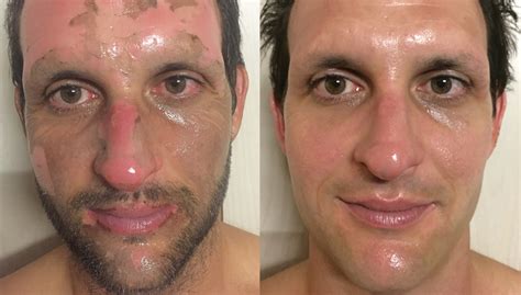 Scotts Scarring Story Acne Scar Treatment By Dmk
