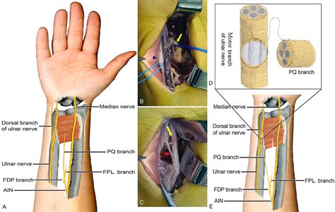 Ulnar Nerve Decompression And Transposition With Versus Without