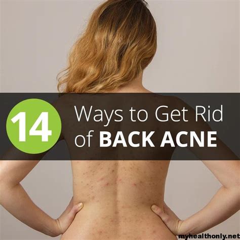 14 Best Home Remedies For Back Acne You Must Know My Health Only