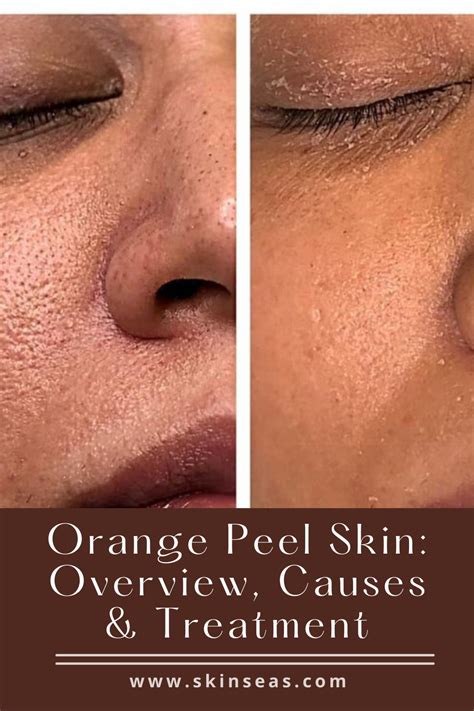 How To Fix Large Pores Orange Peel Skin In 2021 Orange Peel Skin