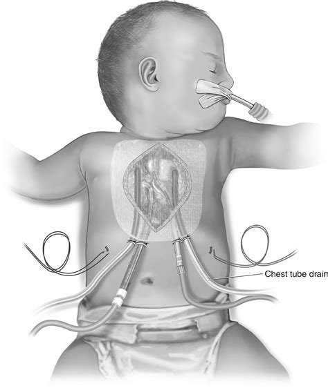 Extracorporeal Cardiopulmonary Resuscitation Ecpr Initiation And Surgical Technique In The