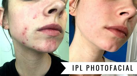 Ipl Photofacial Before And After Four Weeks Youtube