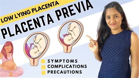 What Is Low Lying Placenta Placenta Previa Symptoms And