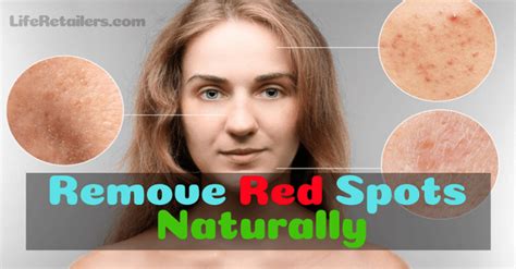 How To Remove Or Get Rid Of Red Spots On The Skin Naturally Life