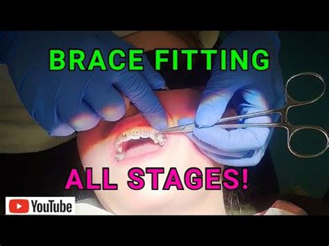 How Braces Are Put On Amazing Orthodontist Explained Each Step