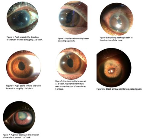 Pupillary Abnormalities After Glaucoma Tube Shunt Surgery Eyewiki