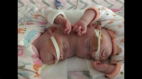 Formerly Conjoined Twins Thriving After Separation Surgery Fox News