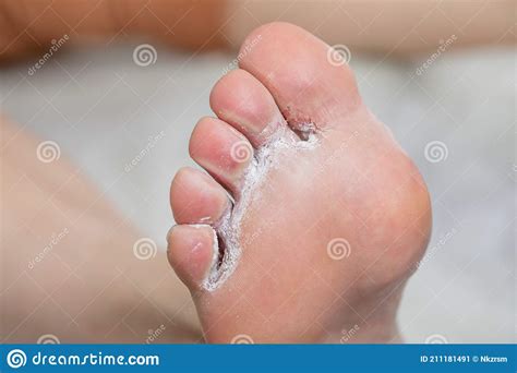 The Diseased Foot With Hyperhidrosis Is Sprinkled With Talcum Powder