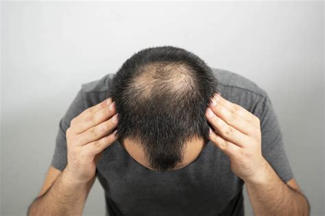 Male Pattern Baldness Questions Answered Smp Ink