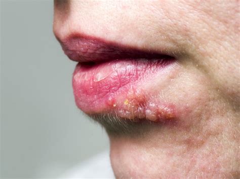 Tingling In Face Causes Diagnosis And Treatment