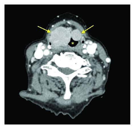 Axial Contrast Enhanced Ct Scan At The Level Of True Vocal Cords