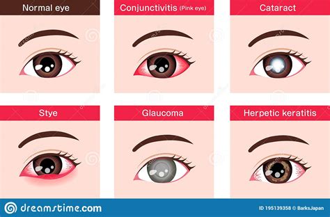 Various Eye Diseases Vector Illustration Female Eye Stock Vector