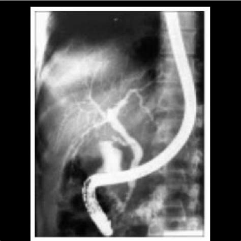 Ercp Showing Leak From Duct Of Luschka Download Scientific Diagram