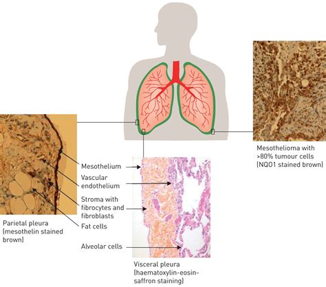 Maybe you would like to learn more about one of these? Malignant pleural mesothelioma: history, controversy and ...