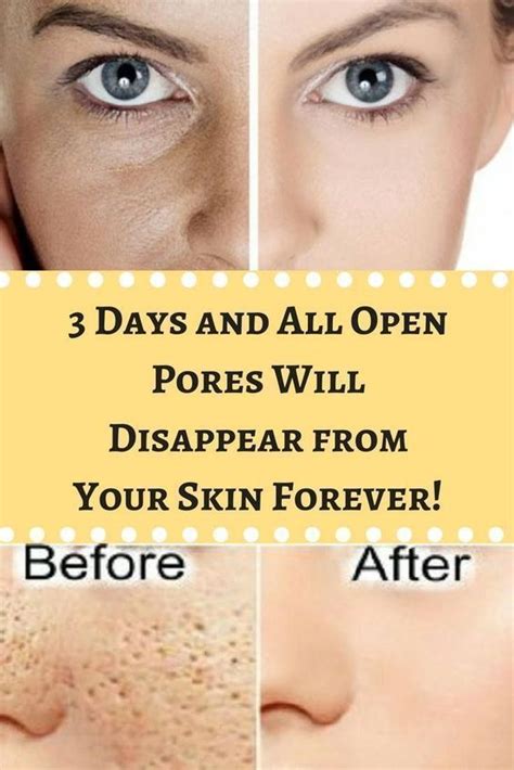 How To Get Rid Of Enlarged Pores Naturally Reduce Pore Size Reduce