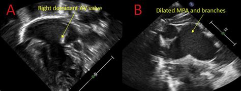 A Apical View Of Unbalanced Right Dominant Atrioventricular Av