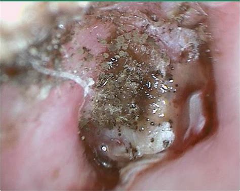 This picture shows a culture that grew out a staph infection and a fungal infection called malassezia. ASK DIS: Otomycosis