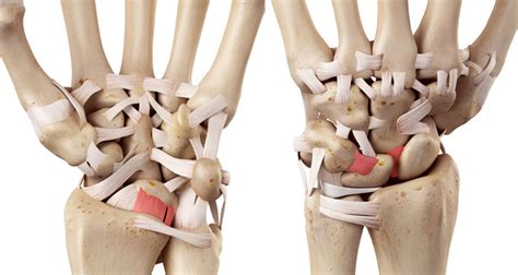 Sprained Wrist Symptoms Causes Treatment And Rehabilitation