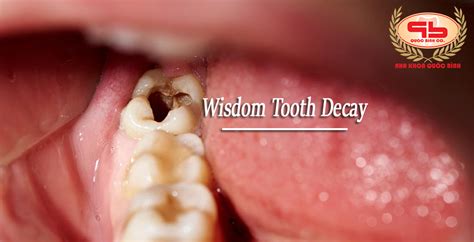 What To Do When Having A Wisdom Tooth Decay