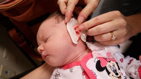 Newborn Ear Correction Earwell Therapy Aaryn Williams Baby Brush