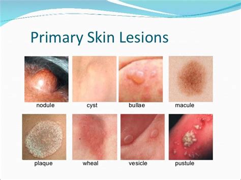 Skin Lesions Pediatric Nursing Skin Disorders Respira