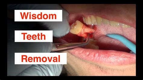 How Much Is It To Get A Tooth Removed Without Insurance Blog Infolensa Com