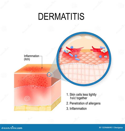 Atopic Dermatitis Atopic Eczema Stock Vector Illustration Of Diagram