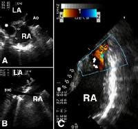 The diagnosis of coronary sinus asd was established by using transesophageal echocardiography after percutaneous closure of a small secundum asd at another center. Atrial septal defect echocardiography sinus venosus - wikidoc