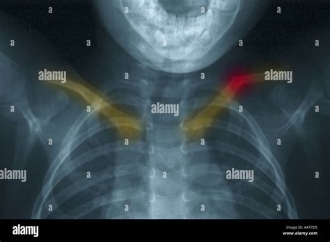 Collarbone X Ray Hi Res Stock Photography And Images Alamy