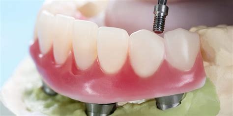 Dental Implants The Center For Implant And General Dentistry