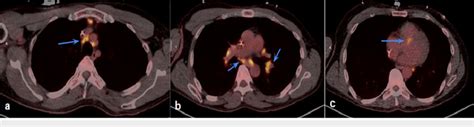 Pet Ct Chest Shows Hypermetabolic Activity Among Cardiac And