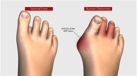 New Bunion Treatment Allows Patients To Walk Within Days Youtube