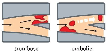 Trombose é um componente do sangue que é formado em vasos sanguíneos. Wat is een tia? - Hersenstichting