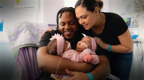 Conjoined Twins Texas 3 Month Old Sisters Successfully Separated After