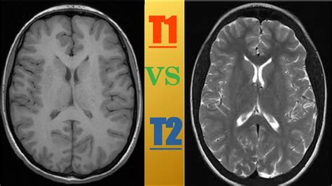 Mri Basic T1 Weight Vs T2 Weight Images Characteristic Youtube