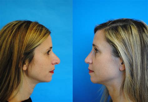 Revision Rhinoplasty Rhinoplasty Nose Surgery Nose