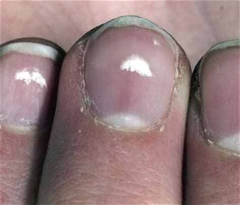 Leukonychia A K A White Spots On Fingernails Or White Nails My Xxx