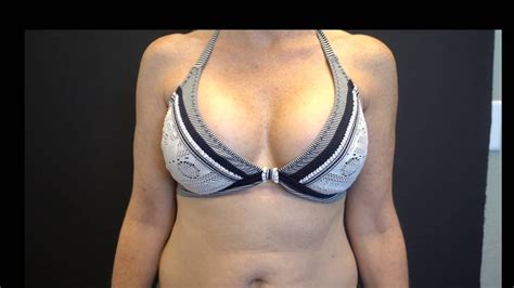 Breast Augmentation Results In A Bikini Cc Smooth Round Silicone High Profile Implants Youtube
