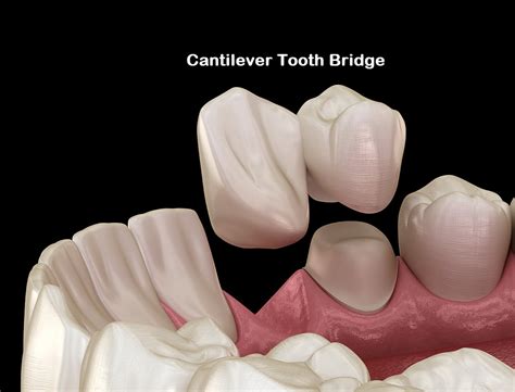 Dental Bridge Pure Dentistry