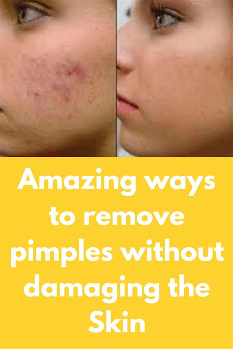 Amazing Ways To Remove Pimples Without Damaging The Skin How To