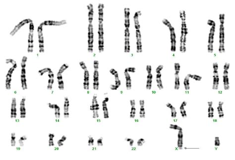 A Karyotype Of The 2 Nd Patient With X Chromosome Showing Fragile Site