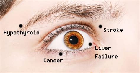 5 Rare Eye Conditions You Didnt Know Existed — The Second Angle