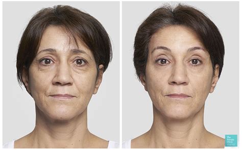 Costs Of Facial Rejuivination
