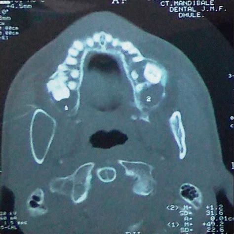 Pdf Multiple Multifocal Odontogenic Keratocysts In Non Syndrome